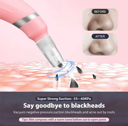 PoreVac Pro™ Blackhead Remover Vacuum – Deep Pore Cleaner Kit